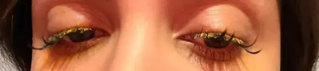 Güzelleşeyim derken az daha kör oluyordu